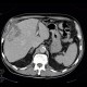 Hepatocellular carcinoma, subcapsular bleeding: CT - Computed tomography